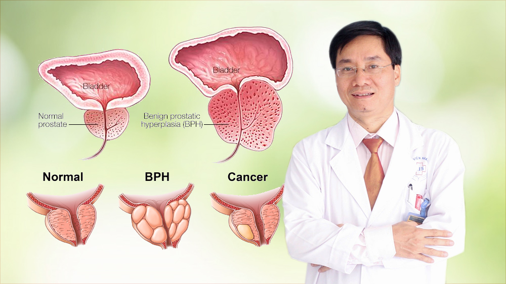TS.BS Trương Hoàng Minh: Những bệnh thường gặp ở tuyến tiền liệt
