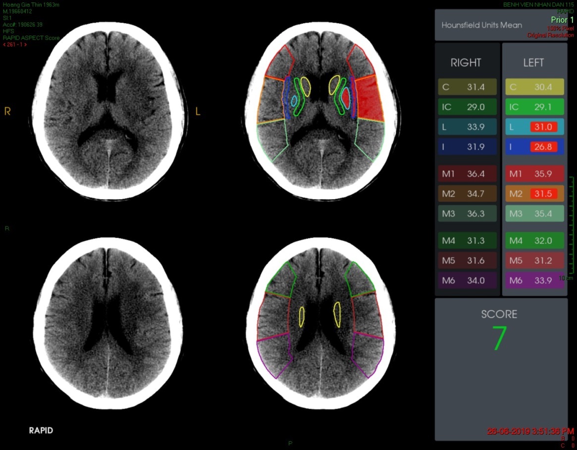 Ứng dụng phần mềm trí tuệ nhân tạo RAPID điều trị nhồi máu não đến sau 6 giờ tại Bệnh viện Nhân dân 115