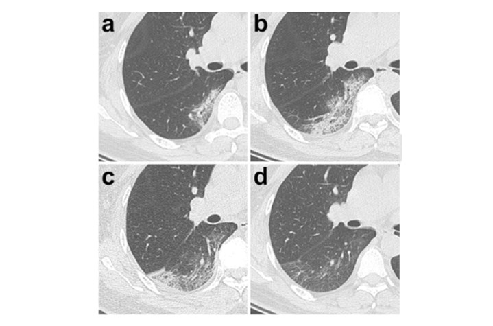 Hình ảnh học thương tổn phổi của bệnh nhân nhiễm virus SARS-COV-2 trong dịch COVID-19