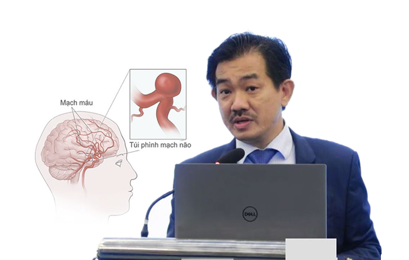TTƯT.PGS.TS.BS Nguyễn Huy Thắng: Nên làm gì khi có túi phình động mạch não chưa vỡ?