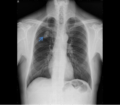Pulmonary Hamartoma (Mô thừa dạng bướu của phổi) - Bệnh viện Nhân Dân 115