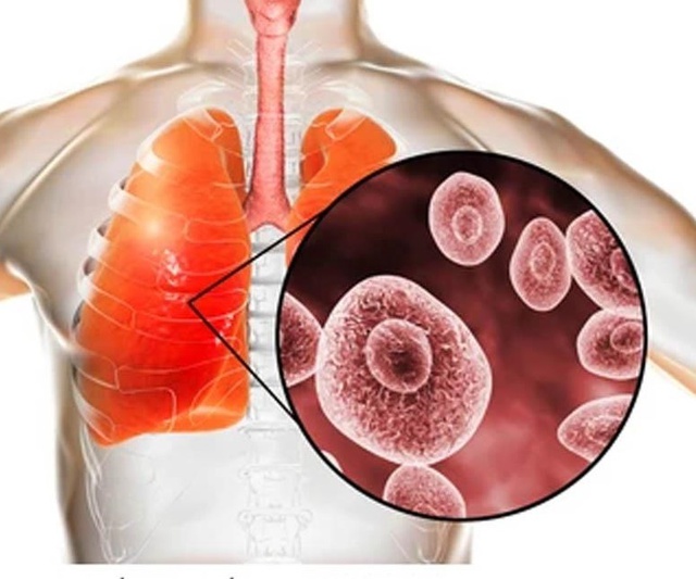 Bệnh nấm phổi do Aspergillus